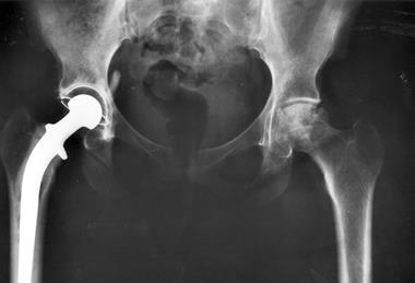Hip_replacement_Image_3684-PH