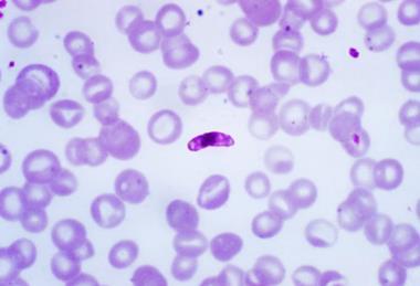 Macrogametocyte_of_the_parasite_Plasmodium_falciparum_PHIL_2701_lores