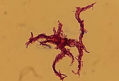 Serpentine_cords_of_red-stained,_acid-fast_structure_in_a_Ziehl-Neelsen_stained_smear_of_Mycobacterium_tuberculosis_complex_(MTBC)_from_liquid_culture