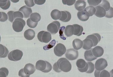 P.falciparum-gametocytes