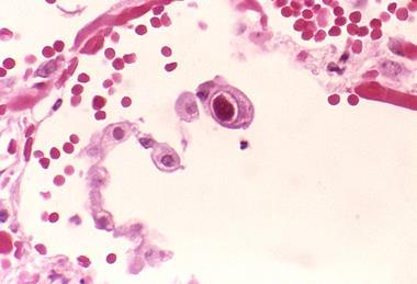 Cytomegalovirus_01