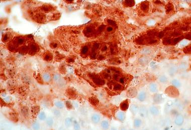 Low-Grade_Papillary_Urothelial_Tumor_of_Bladder_with_Herpes_Simplex_Virus_Infection_(8534832864)