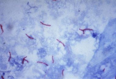 Mycobacterium_tuberculosis_Ziehl-Neelsen_stain_02 (1)