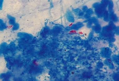 Mycobacterium_tuberculosis_in_Ziehl-Neelsen_stained_smear_of_sputum