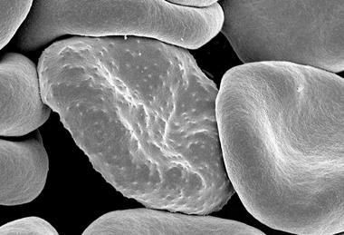 Red_blood_cells_infected_with_malaria