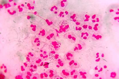 Neisseria_gonorrhoeae_in_urethral_discharge