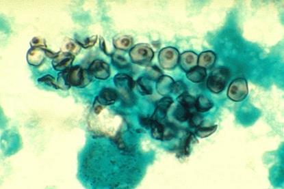 Pneumocystis_carinii_in_smear_from_BAL_01ee046_lores
