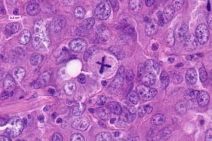 Pathologic_mitosis