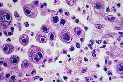 Cytomegalovirus_infection_-_Case_301_(35104826390)