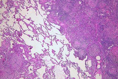 Pulmonary_tuberculosis_(6545189731)