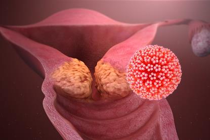 HPV_causing_cervical_cancer