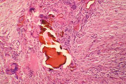 Fecal_matter_foreign_body