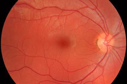 Fundus_photograph_of_normal_right_eye
