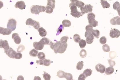 Plasmodium_falciparum_malaria,_1000x