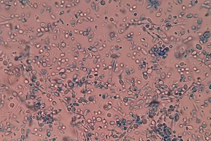 Malassezia_in_LPCB_Tease_Mount_Microscopy