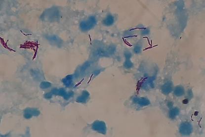 Acid_fast_bacilli_of_Mycobacterium_tuberculosis