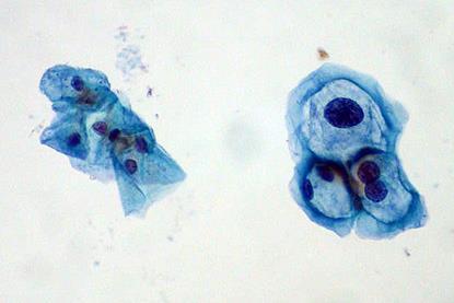 ThinPrep_Pap_smear_HPV