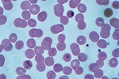 Malaria_falciparum_ring_forms