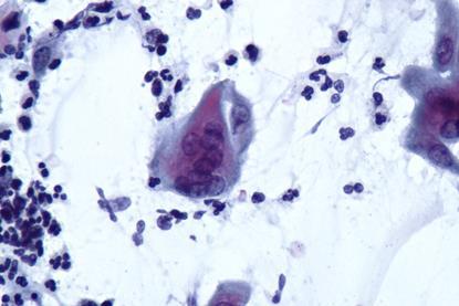 Infección_vaginal_por_virus_herpes_(9361174718)