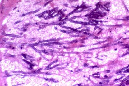 Aspergillosis,_angioinvasive,_intravascular_(5390967599)