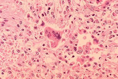 Measles_pneumonia_-_Histopathology