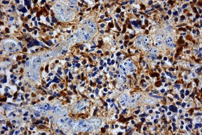 Glioblastoma_GFAP