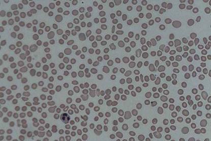 Thrombocytopenia_1
