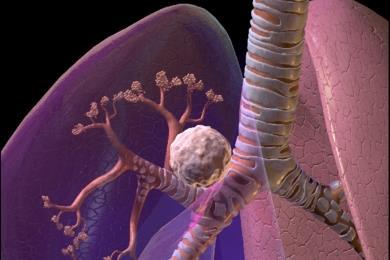 Blausen_0619_LungCancer