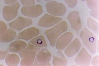 Plasmodium_falciparum_in_Red_Blood_Cells