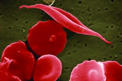 Sickle_cells_illustration