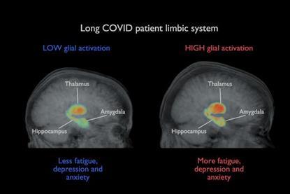 Low-Res_Covid-patient_brain-image