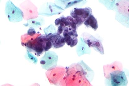 Herpes_simplex_virus_pap_test_2