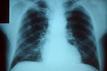 Pneumonia_x_ray