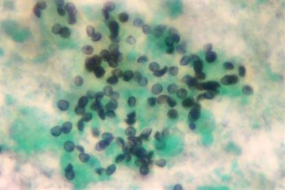 Pneumocystisjiroveci