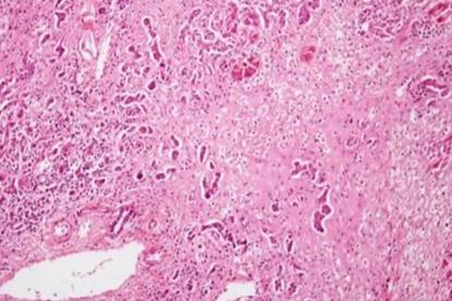 Histopathology_of_massive_hepatic_necrosis_in_hepatitis_B (1)