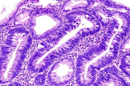 960px-Colon_adenoma_(1)