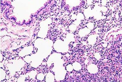 pulmonary_fibrosis-m-1140x760