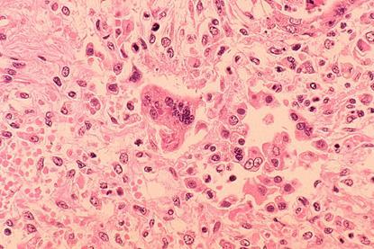 Measles_pneumonia_-_Histopathology