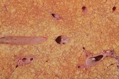 Cirrhosis_liver