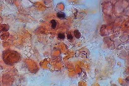Pneumococcus_in_Gram-Stained_BAL_Sample