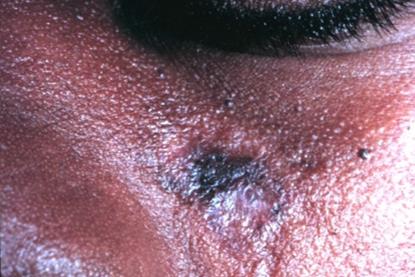 Discoid_lupus_erythematosus