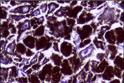Histopathology_of_Malignant_melanoma