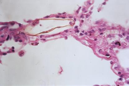 Schistosomiasis_(13382771945)