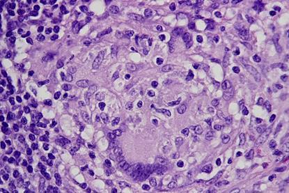 Granulomas_in_an_intestinal_lymph_node_in_Crohn's_disease,_HE_5