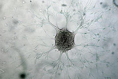 Immagine_di_cellula_di_Glioblastoma_multiforme_della_mia_linea_cellulare_patentata_presso_ECACC_ANGMCSS