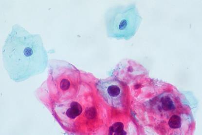 CIN_1-HPV_on_ThinPrep