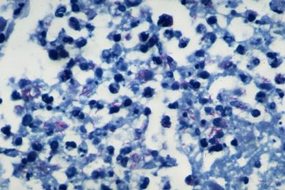 Pulmonary_tuberculosis_-_Numerous_acid_fast_bacilli_in_area_of_acute_inflammation_(6545178883)