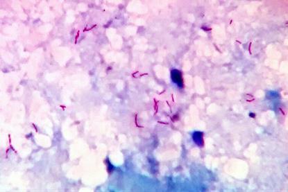 Acid_fast_bacilli_in_sputum_smear