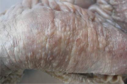 Tuberculosis_of_ileum_showing_serosal_tubercles