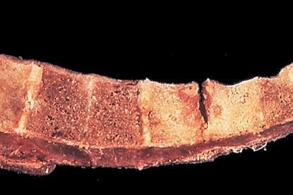 Tuberculosis_of_spinal_column_(6539943165)